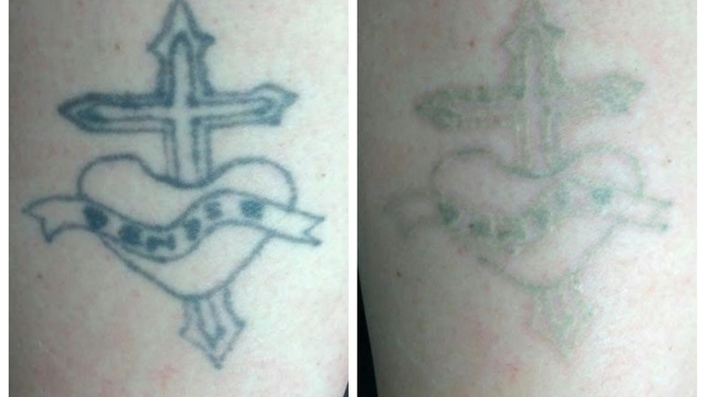 How Expensive Can Tattoo Removal Seem?