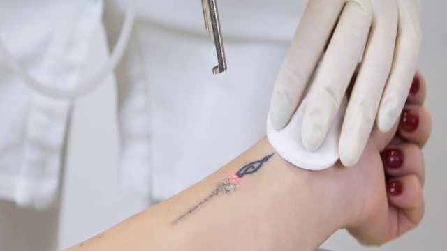 Tattoo Removal Options – Laser Tat Removal And Even A Tattoo Removal Cream
