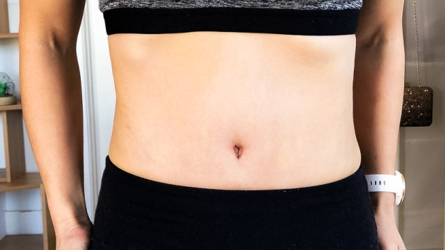 Flatten Your Tummy: Exploring the Benefits of Abdominoplasty