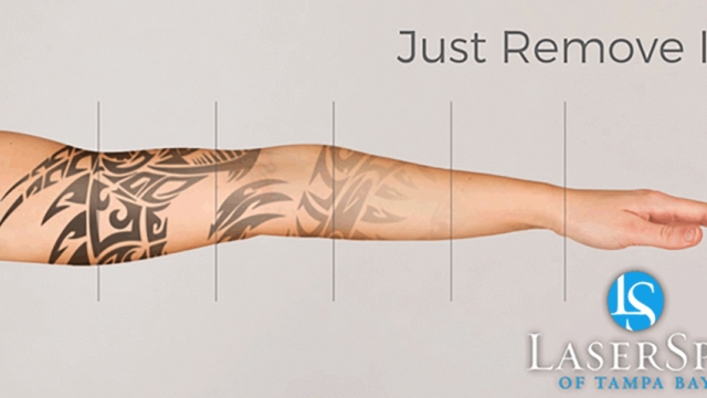 Tattoo Removal Procedure – Your Selection For A Tattoo That Could Be Removed
