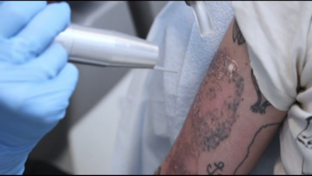Types Of Tattoo Removal For Those Considering Tattoo Removal