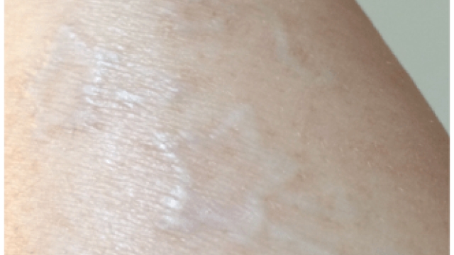 Laser Tattoo Removal – Frequently Asked Questions