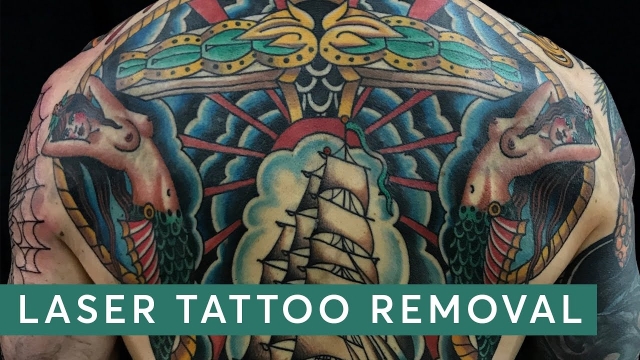 Tattoo Removal – This Is The Way To Do It Now The Right And Safe Way