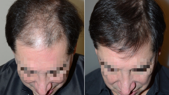 The Secret to Perfect Locks: Unveiling the World of Hair Transplants