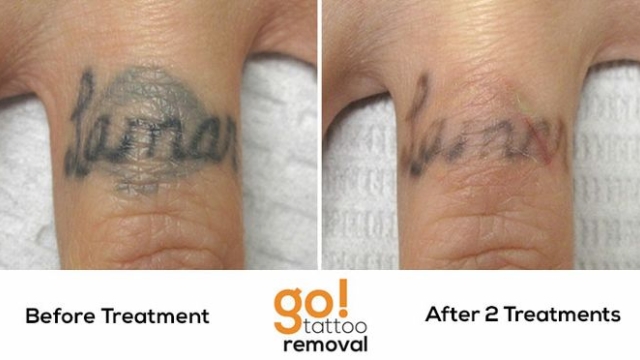 My Tattoo Removal Story