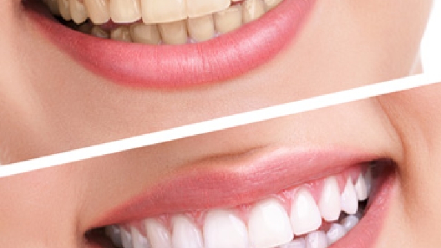 Shining Smiles: Unveiling the Secrets of Teeth Whitening